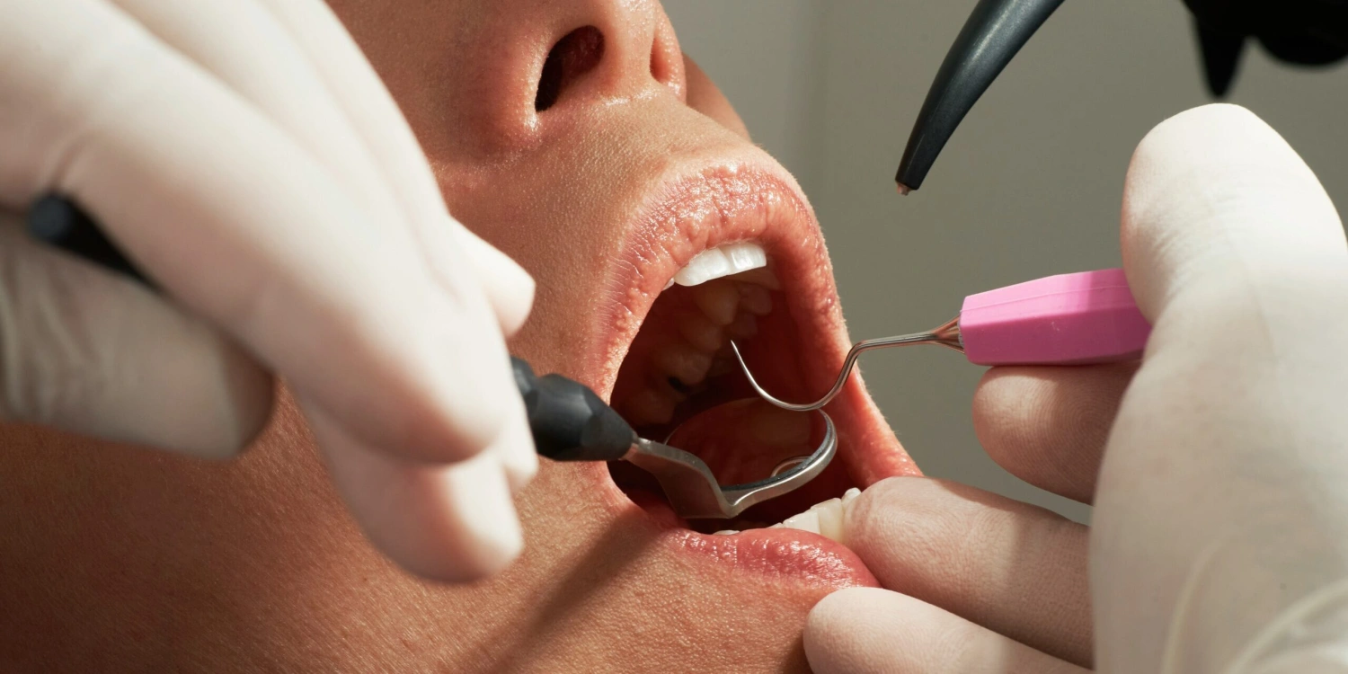 Ranný prehľad Forbesu: Príspevky poisťovní na zubnú starostlivosť od mája končia