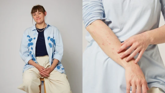 Pre ekzém skončila v nemocnici. Dnes vyrába špeciálne tričká pre atopikov