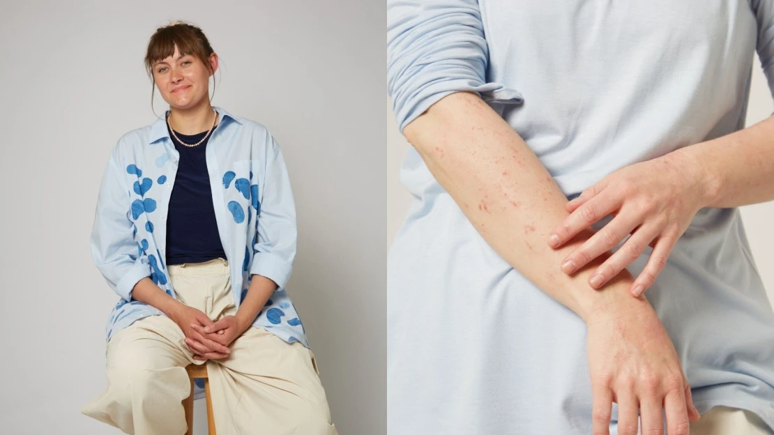 Pre ekzém skončila v nemocnici. Dnes vyrába špeciálne tričká pre atopikov